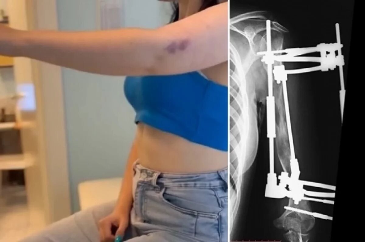    Самарские хирурги удлинили на 13 сантиметров руку 17-летней девушке