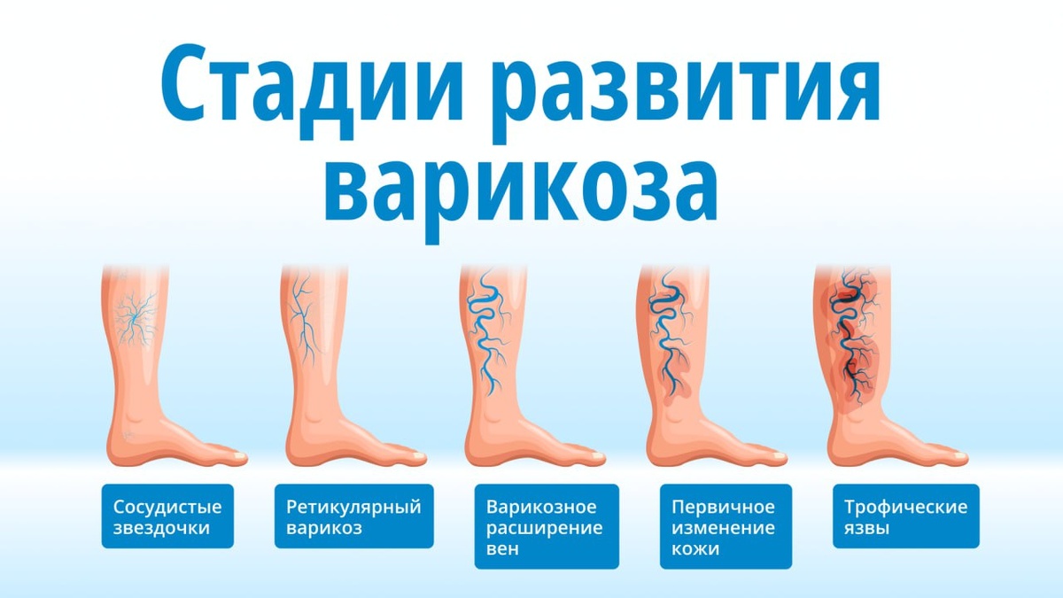 Варикоз: как вены "выползают" на ногах и чем это грозит