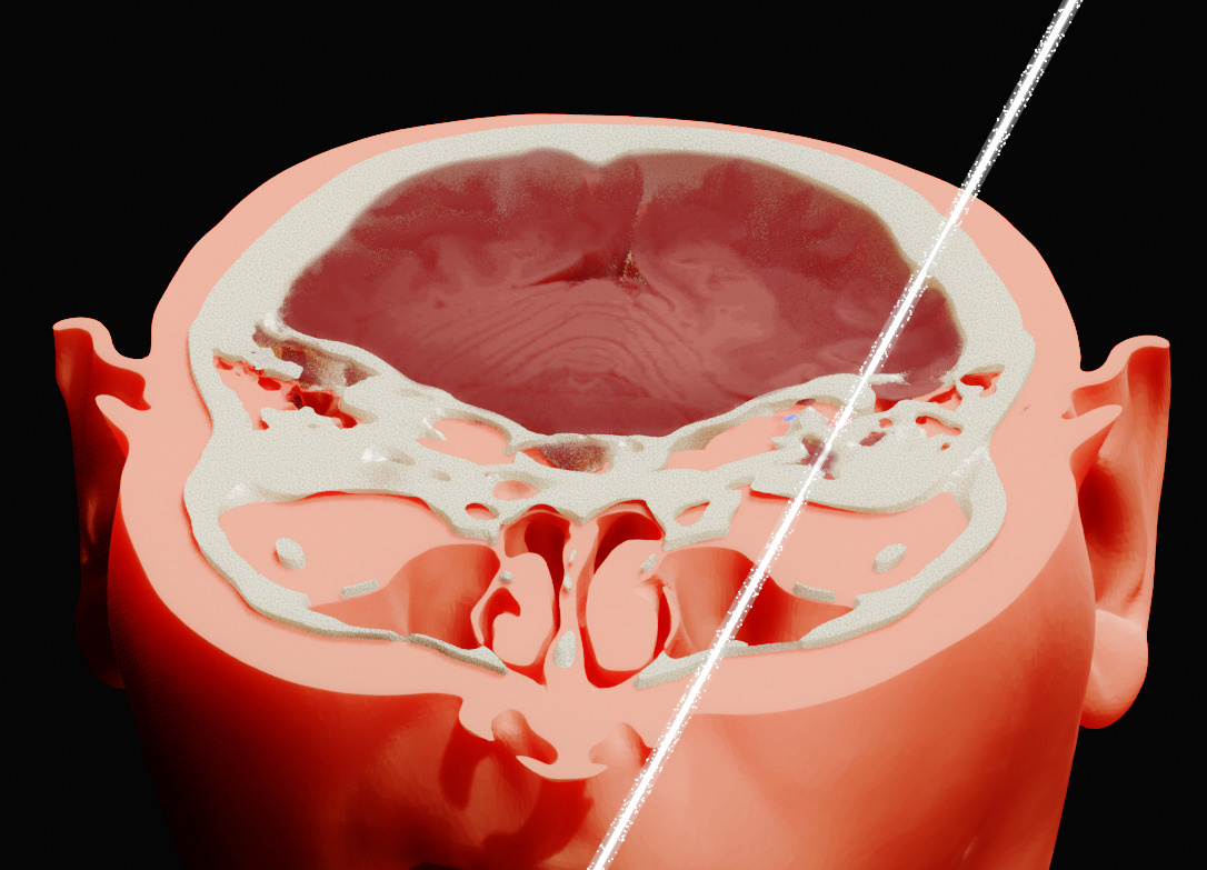 На реконструкции видно, как луч пронзил мозг Бугорского. Изображение: Мораес и Моура, OrtogOnlineMag, 2025 (CC BY 4.0)