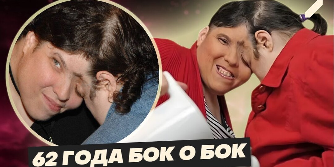 Они были соединены головами: она мечтала о свадьбе, он — о сцене. История сиамских близнецов-долгожителей