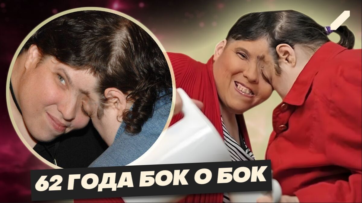 Они были соединены головами: она мечтала о свадьбе, он — о сцене. История сиамских близнецов-долгожителей