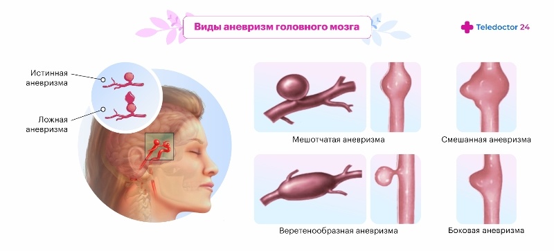 Виды аневризм