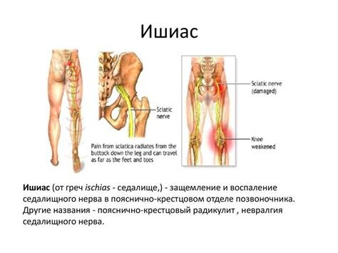 Ишиас: как предотвратить боль в спине и ногах — эффективная профилактика