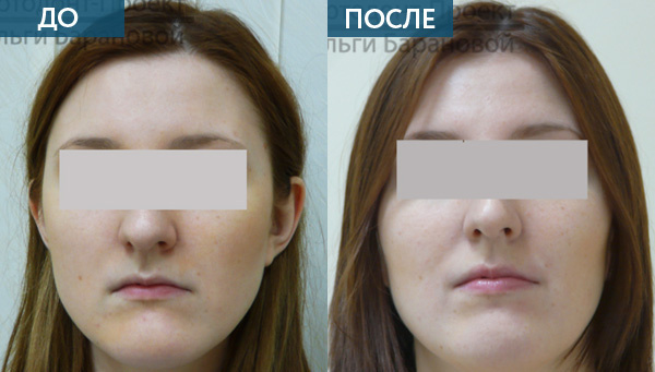 Перекрестный прикус лечение до и после