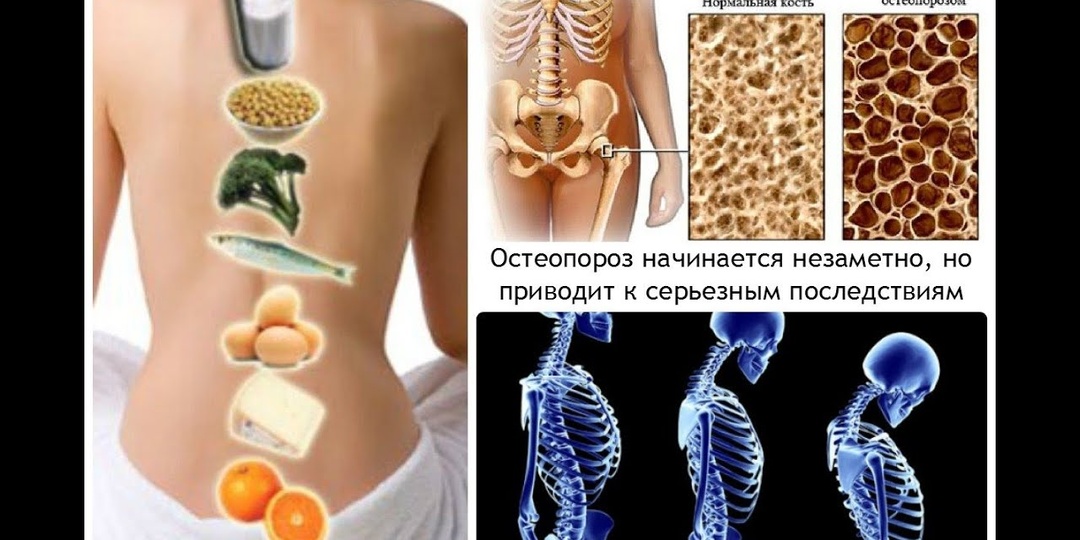 Как предотвратить остеопороз? Комплексная стратегия укрепления костей на всю жизнь