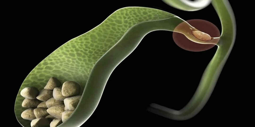 Камни в желчном пузыре: что делать, если обнаружены? Разбираемся без паники — от диеты до операции