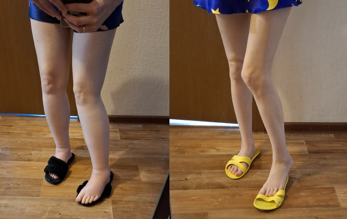 Отеки стали поменьше после выписки