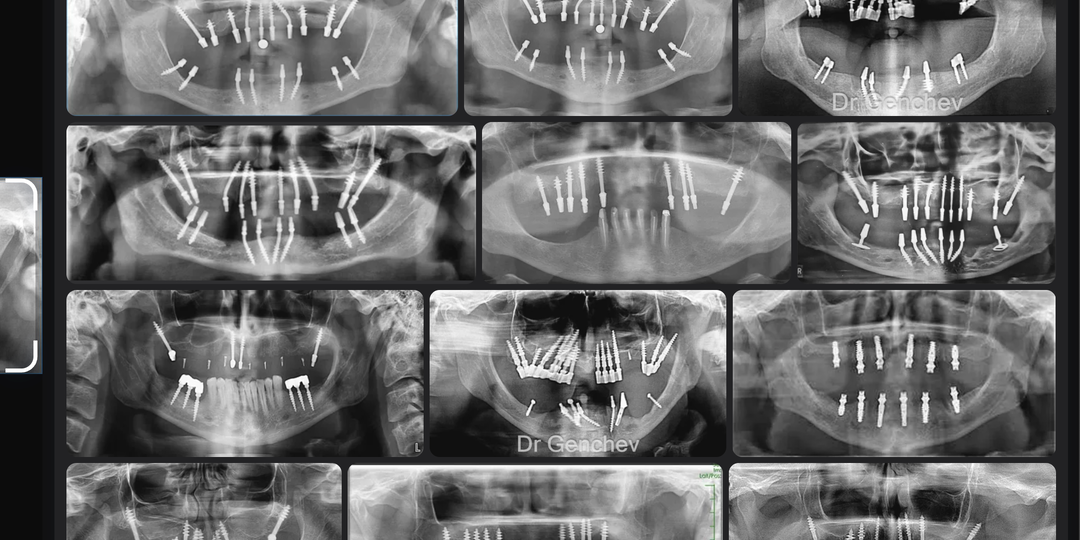 14 базальных имплантатов за 40 минут на 1 челюсть - почему во всём цивилизованном мире отказываются от подобной опасной практики