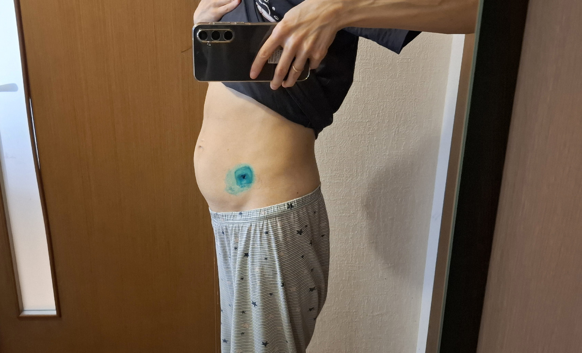 Живот после недели ношения бандажа (примерно 2 недели спустя после лапароцентеза)