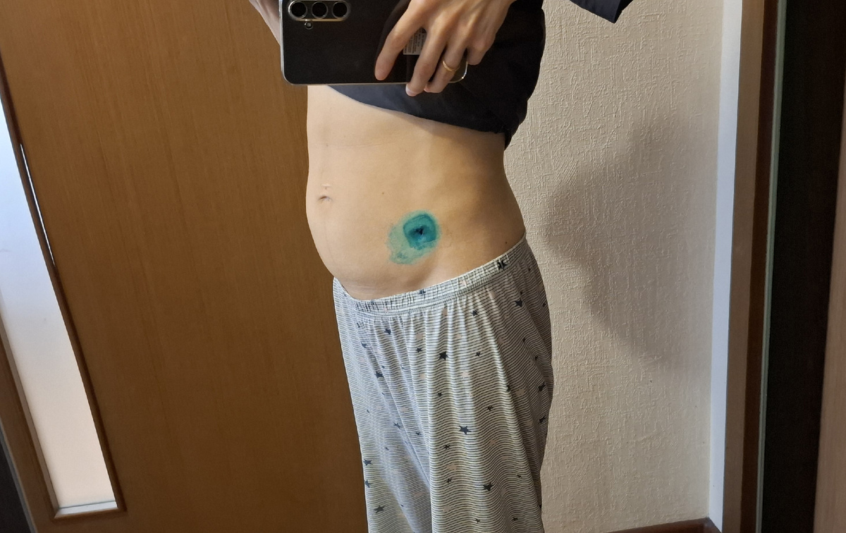 Живот после недели нощения бандажа (примерно 2 недели спустя после лапароцентеза)