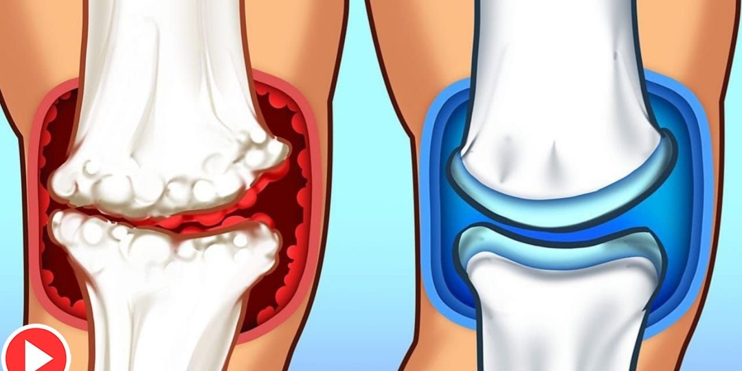 Суставы хрустят? Начинается артроз — не игнорируйте!