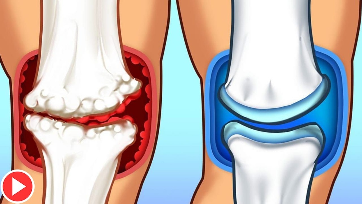 Суставы хрустят? Начинается артроз — не игнорируйте!