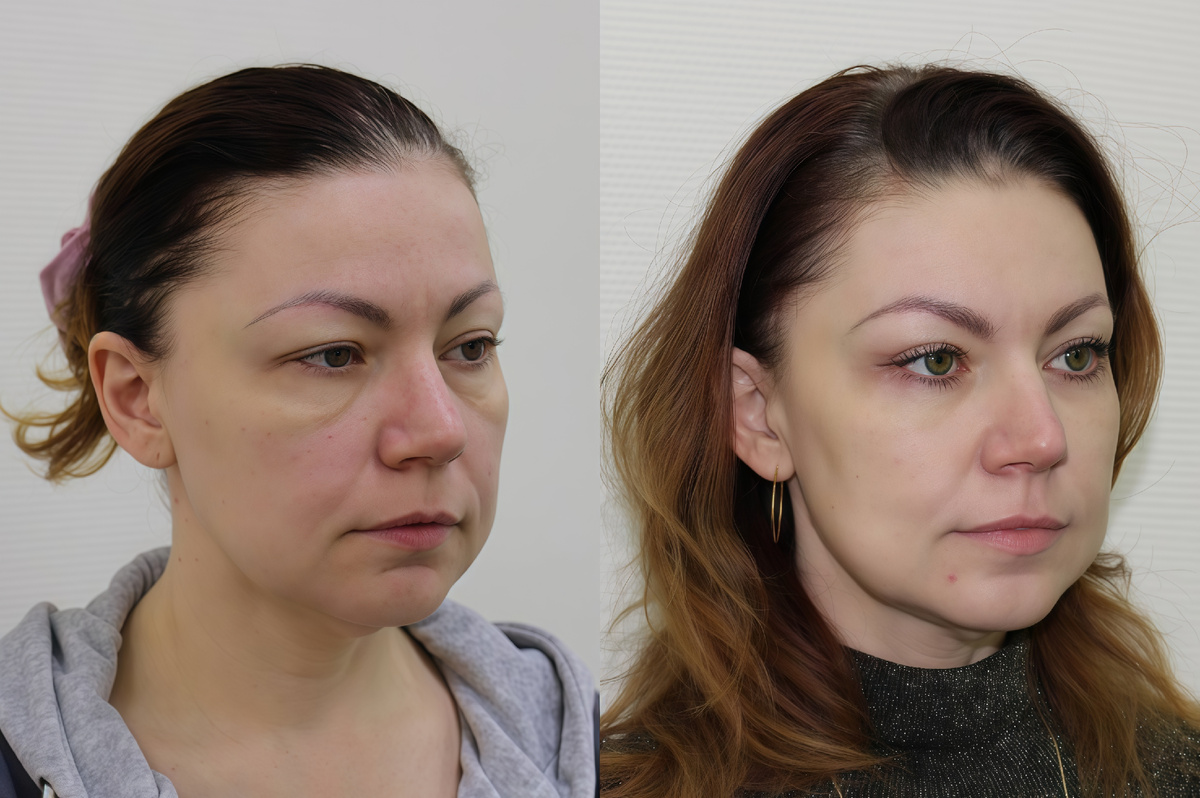 Фото пациента до работы пластического хирурга и после