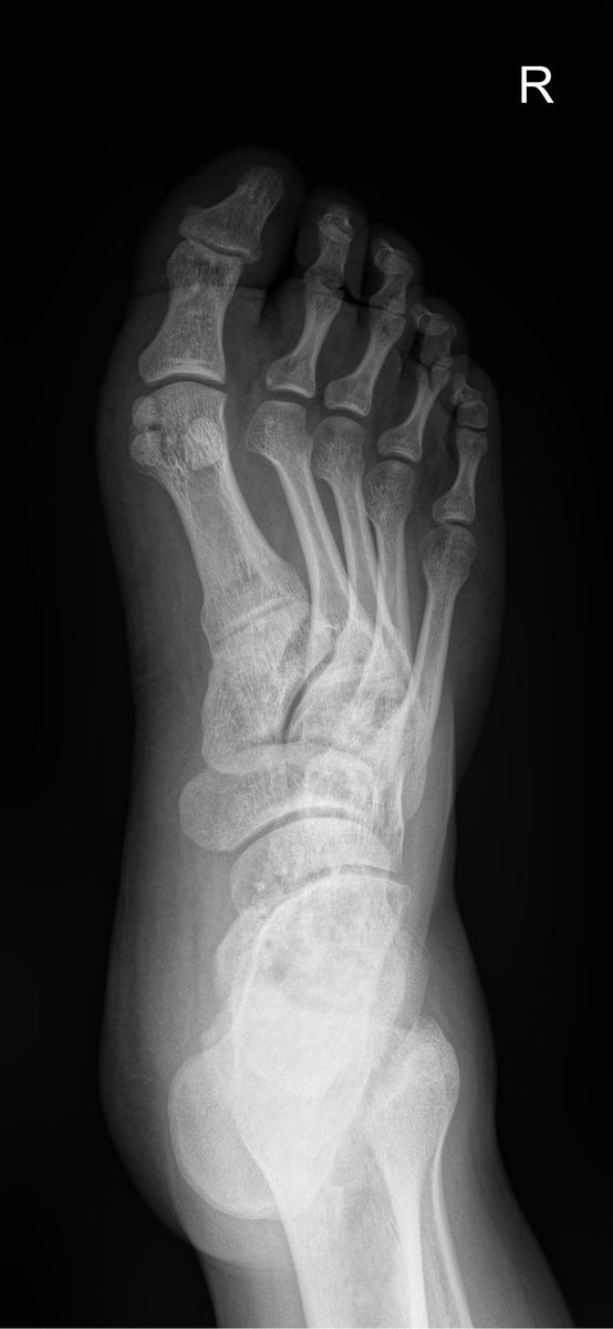 Рентген стопы