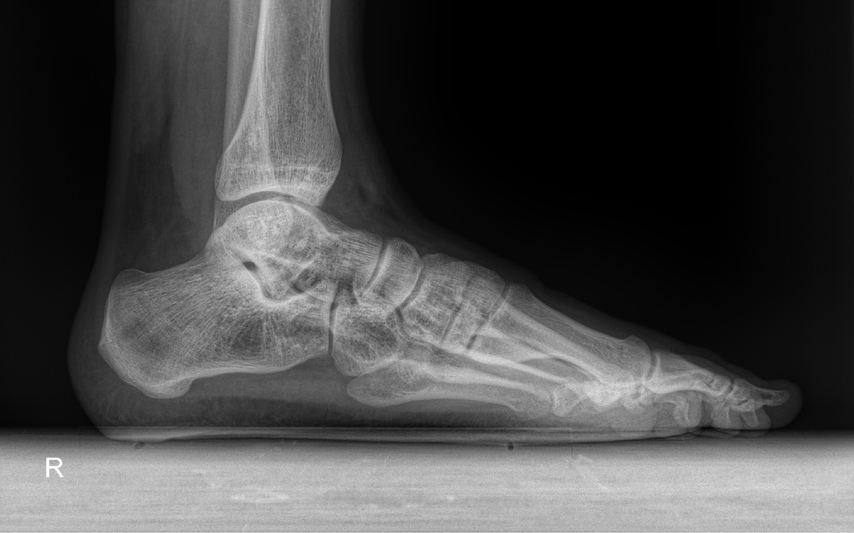 Рентгенограмма правой стопы в двух проектциях