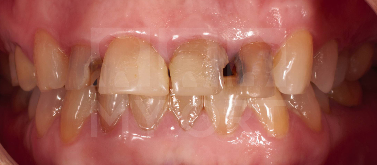 Скол старых пломб передних зубов и дисколорит