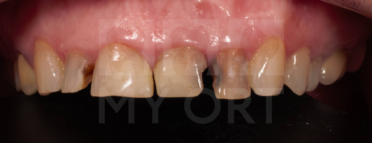 Скол старых пломб передних зубов