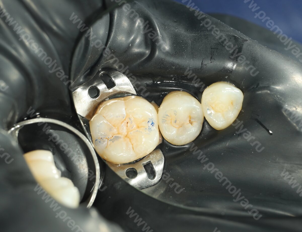 Стоматология Премоляр