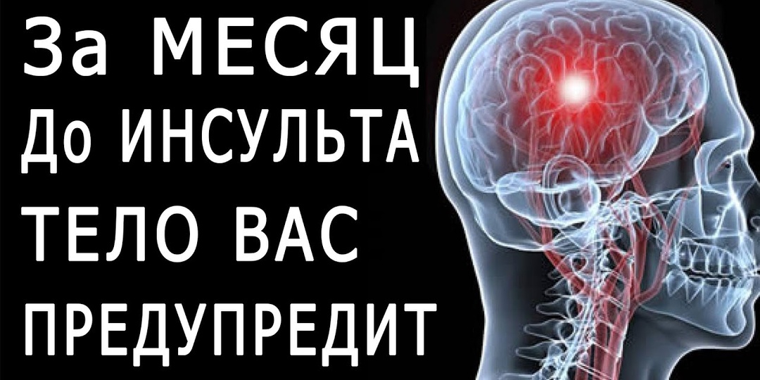 Инсульт ночью: как его предотвратить