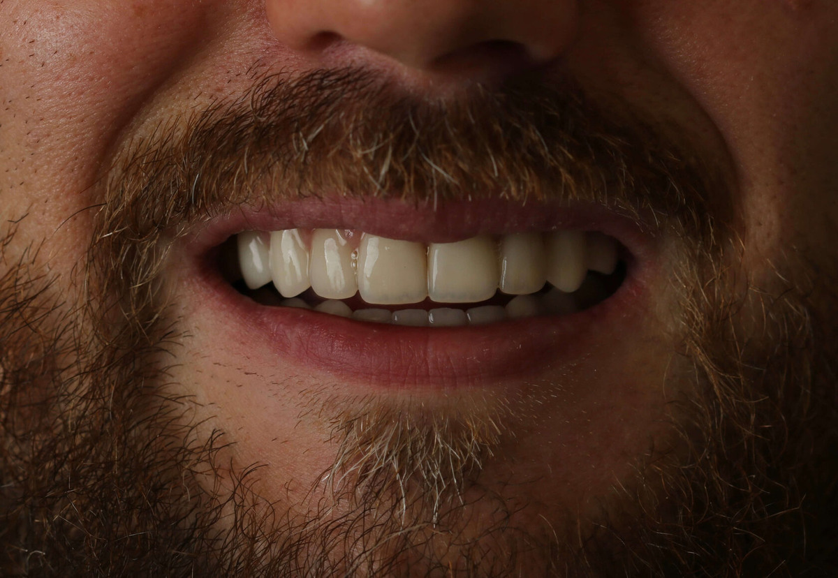 Керамические виниры: результат эстетической реставрации зубов