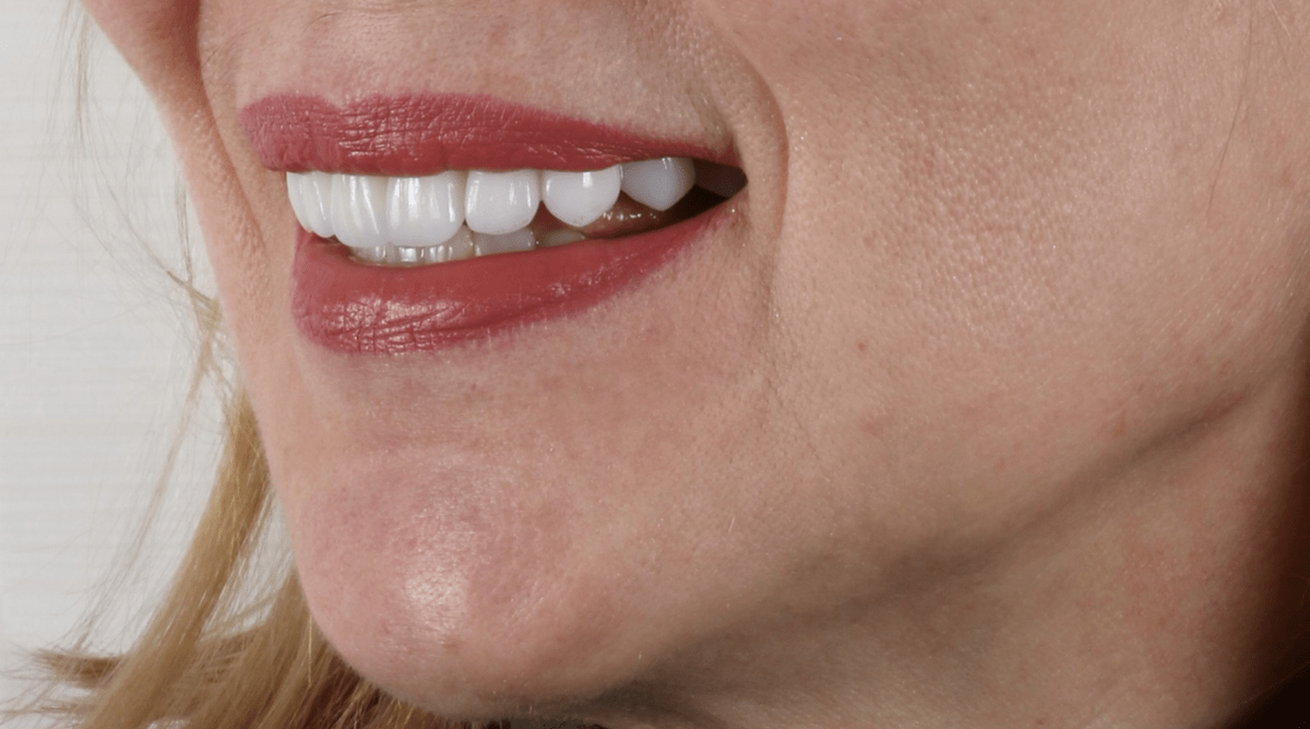 Пластика десны и костная пластика: подготовка к эстетическому протезированию