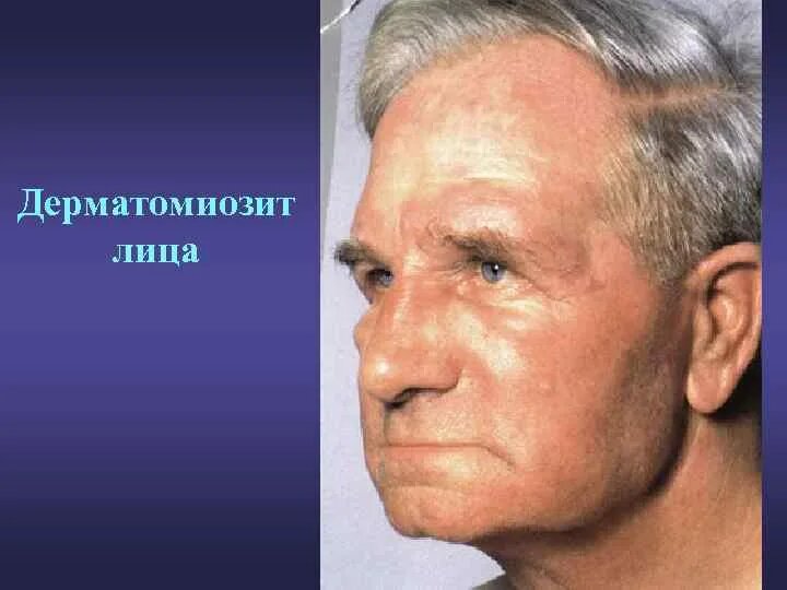 Красное лицо, слабость в мышцах — что, если это не усталость, а дерматомиозит?