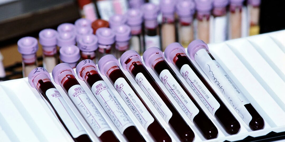 Самые главные анализы для диабетиков: что проверять, чтобы не потерять зрение, почки и ноги