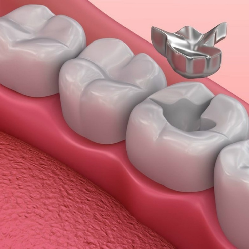 Металлическая восстановительная вкладка