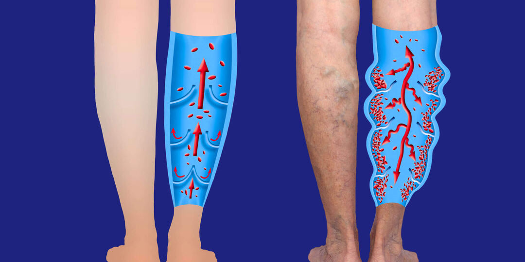 Варикоз и тромбы: чем грозят вены на ногах