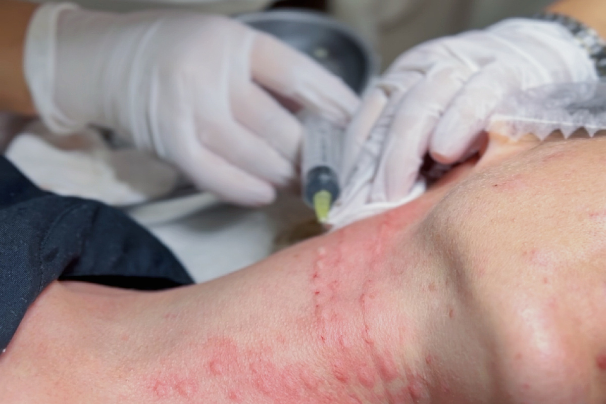 Врач косметолог Керимова А. А. - идеальные папулки и ни единого синячка