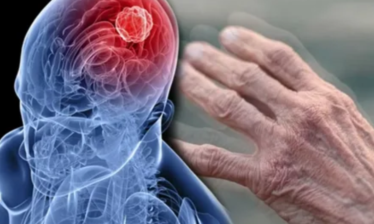 Что такое болезнь Паркинсона и чем характеризуется