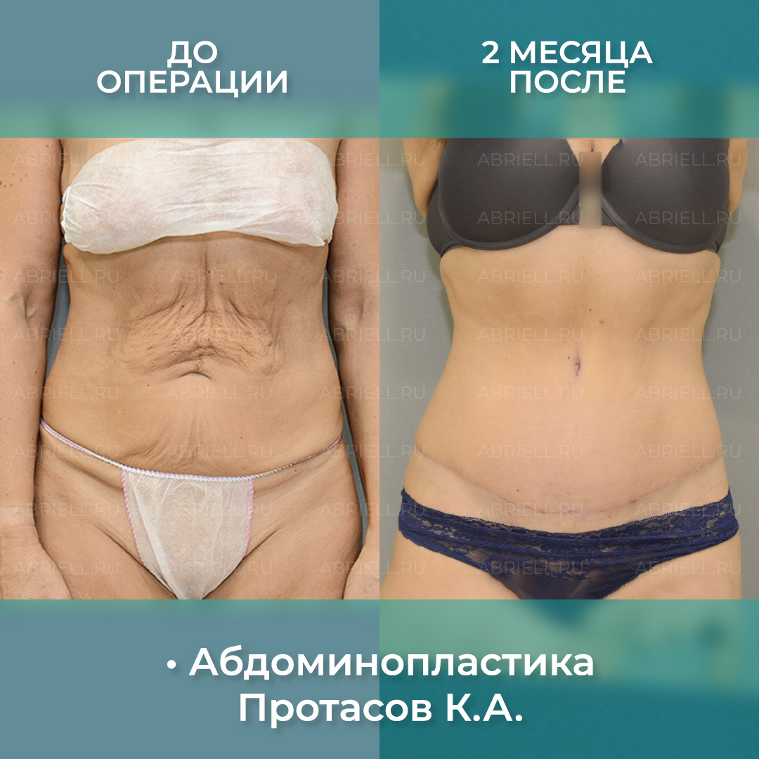 Результат до и после абдоминопластики. Восстановление фигуры после беременности и родов
