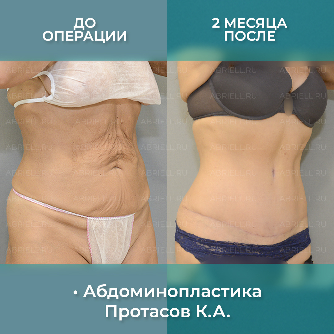 Абдоминопластика - пластика живота в Санкт-Петербурге 