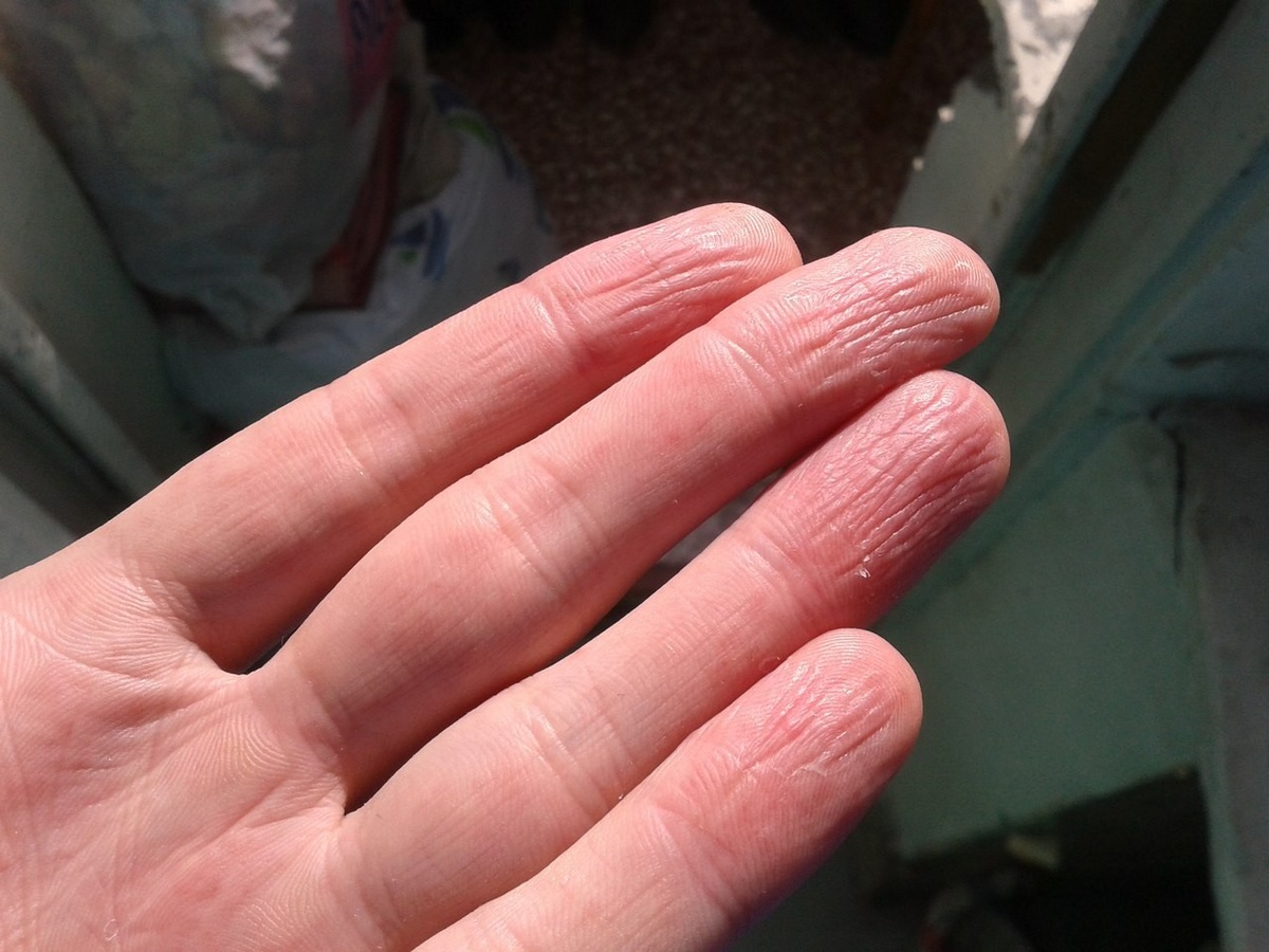 Когда на руках вот такая картинка образуется, это неполадки эндокринной системы так отражаются. Знак 100% рабочий.