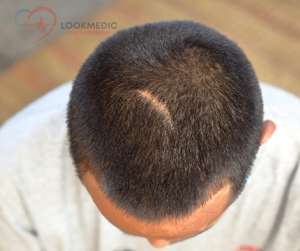 Пересадка влос на шрам