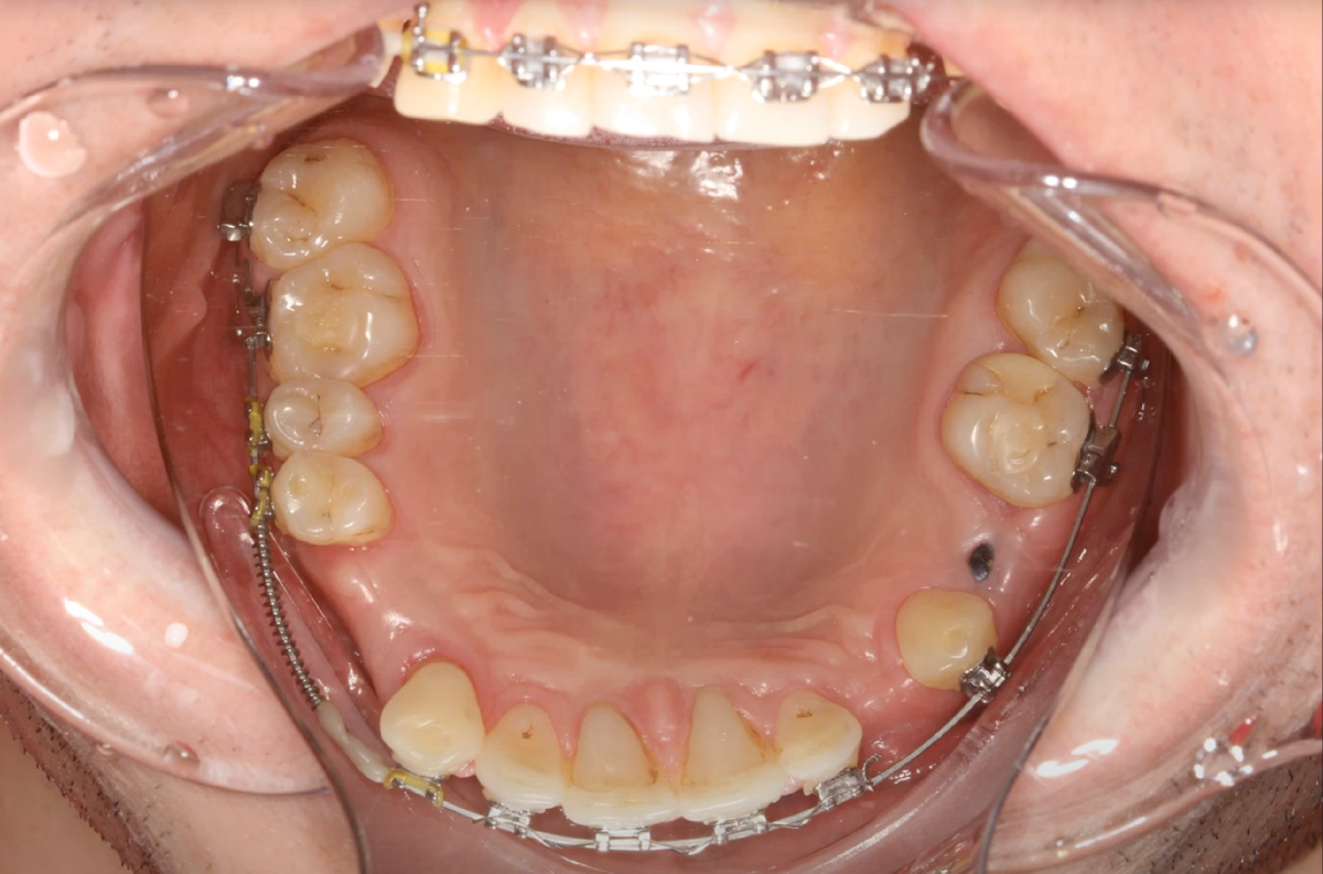  Верхняя челюсть пациента