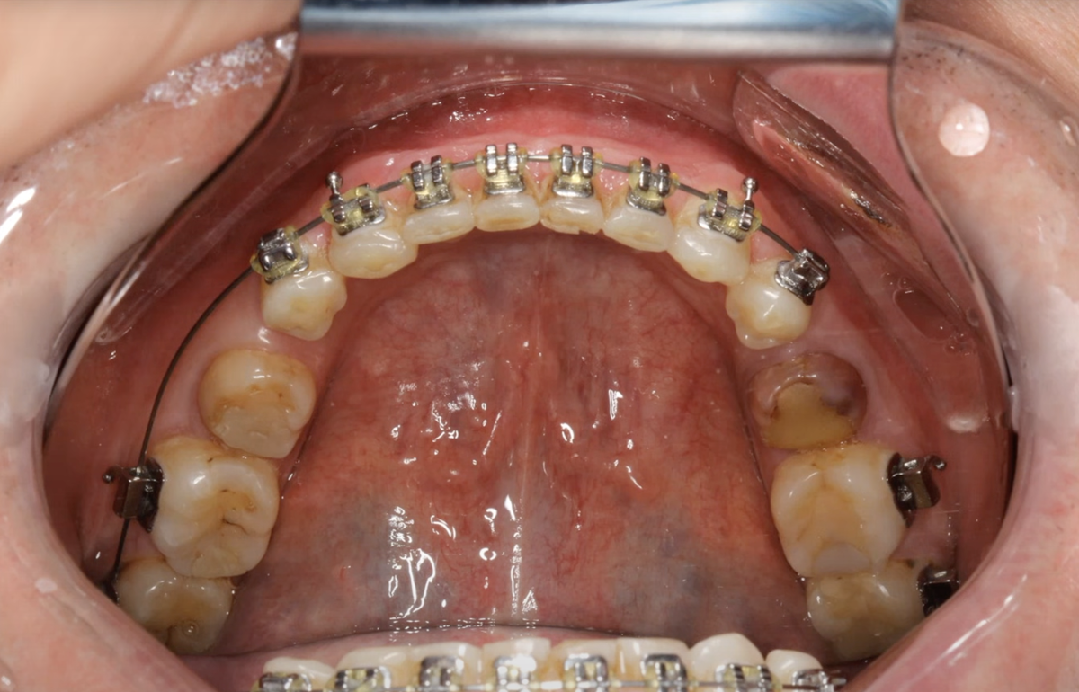 Нижняя челюсть пациента