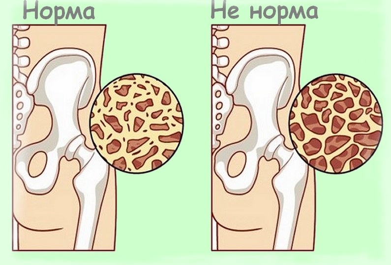 Не творог: вот что реально укрепит ваши кости после 55-ти