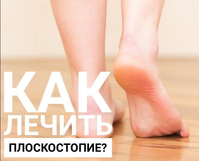 Как лечить плоскостопие