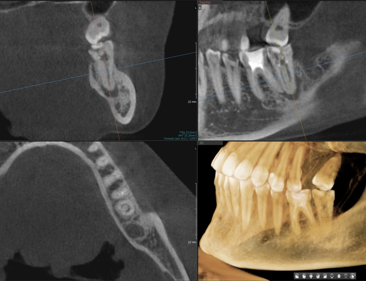 Зуб 3.7 - каналы "пустые", периодонтит (тёмный очаг около верхушки корня)
