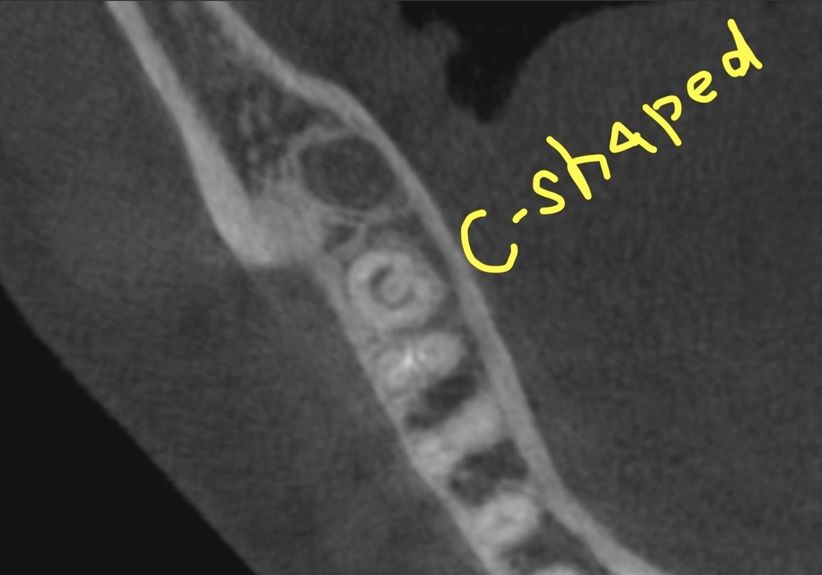 C-shaped каналы в 37 зубе