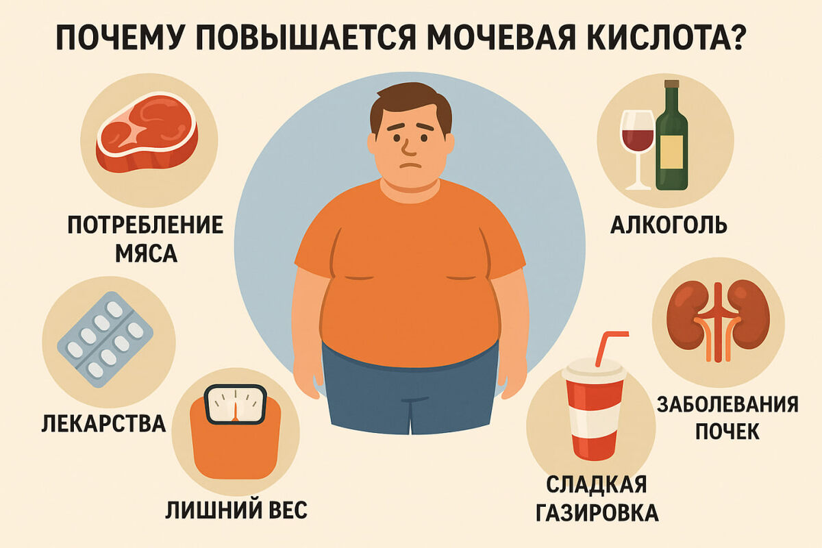 Изображение показывает причины повышения мочевой кислоты, включая употребление мяса, алкоголь, лекарства, лишний вес, сладкие газированные напитки и заболевания почек.