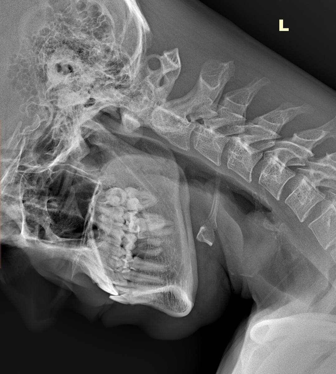 Аномалия Киммерли. Рентген - боковой снимок с согнутой шеей