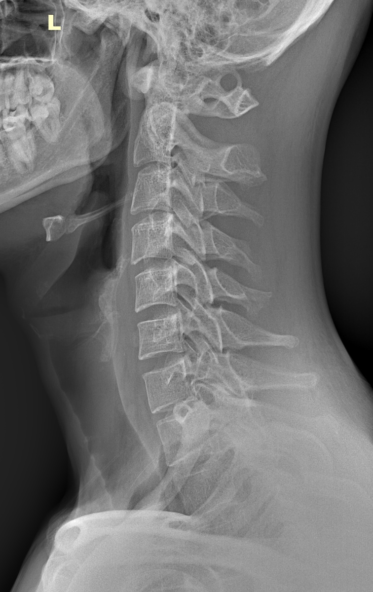 Аномалия Киммерли. Рентген снимок в боковой проекции.