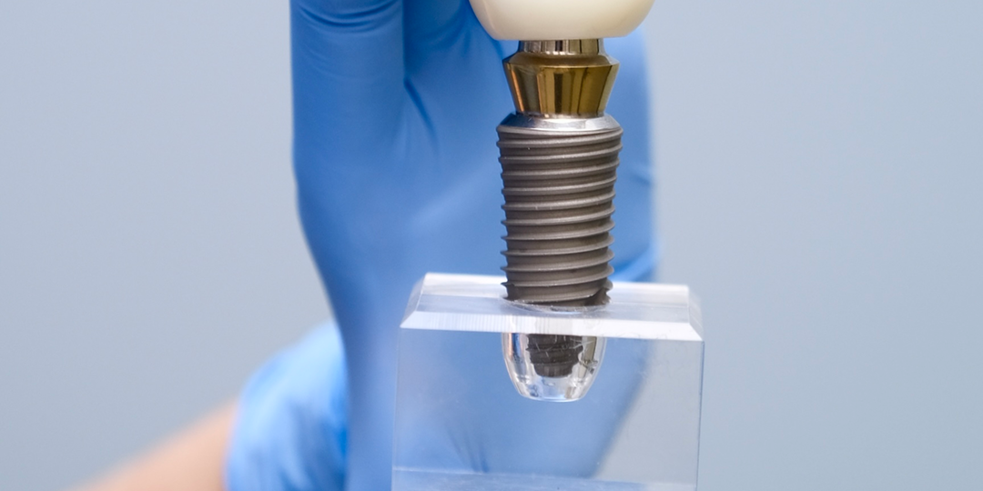 Как проходит постановка зубного имплантата: этапы имплантации пошагово