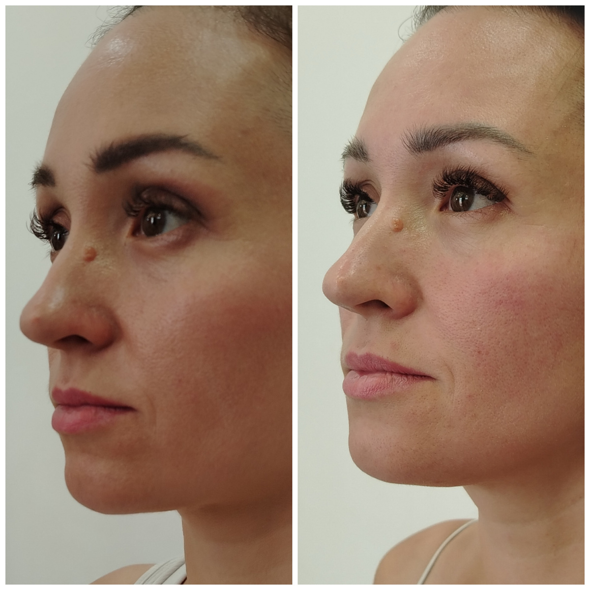 Тут хорошо видно, как поднялась средняя треть и стала меньше нависать носогубка. 