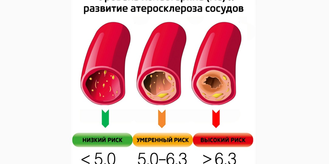 7 лучших упражнений от высокого холестерина: как снизить ЛПНП и поднять ЛПВП без таблеток