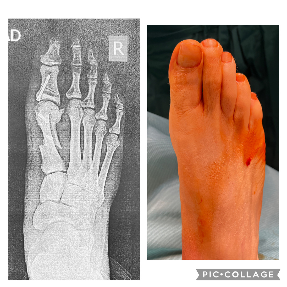 К сожалению, не нашел исходных данных, только рентген сразу после операции. Справа - вид стопы сейчас
