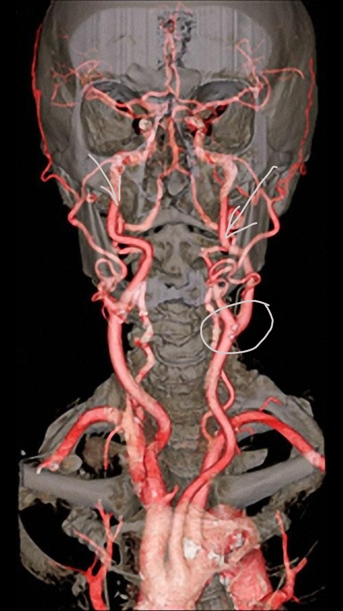 Так выглядит нормальная анатомическая 3Д-картина магистральных артерий шеи и их внутри- и внечерепных ветвей: в круг обведено место деления общей сонной артерии на наружную и внутреннюю (стрелки) сонные артерии. Конечными ветвями каждой ВСА являются передние и средние мозговые артерии, участвующие в кровоснабжении мозга 