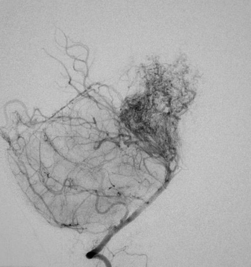 Селективная церебральная ангиограмма демонстрирует то самое "облако дыма" при болезни Мойя-Мойя